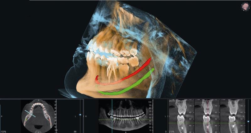 Myray-Proxima-X6-AutoNerveAutoArc